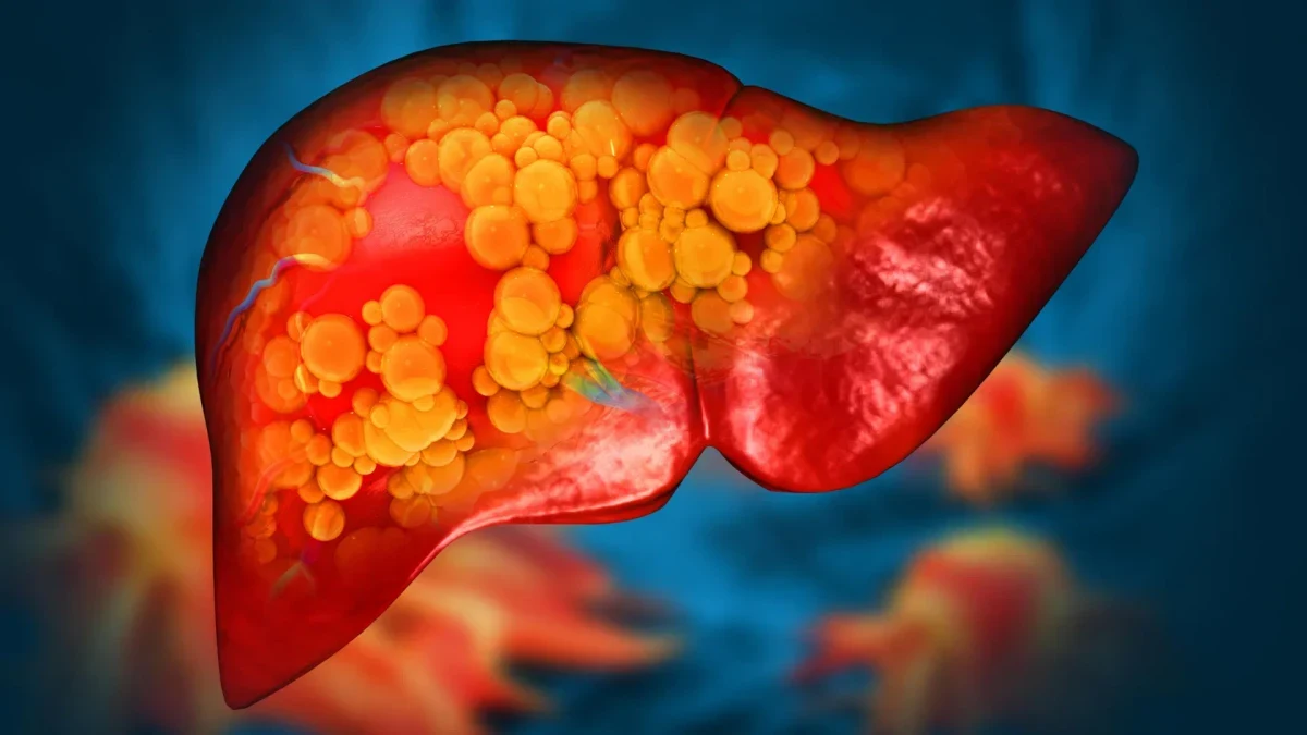 File photo: New drug reverses severe fatty liver disease by repairing the gut ...